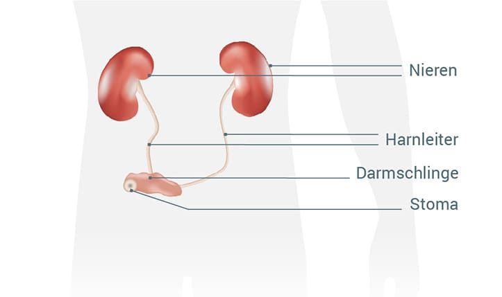 Urostoma: Eine Art Durchlaufkanal leitet den Urin in ein Stoma an der Bauchdecke