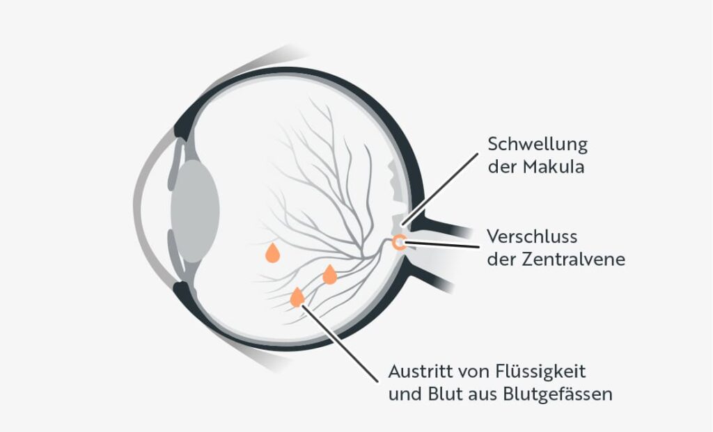Schematische Darstellung eines Querschnitts durch das menschliche Auge mit Markierungen für Schwellung der Makula, Verschluss der Zentralvene und Austritt von Flüssigkeit und Blut aus Blutgefässen