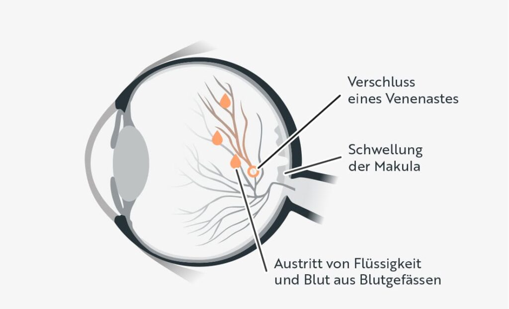 Schematische Darstellung eines Querschnitts durch das menschliche Auge mit Markierungen für Verschluss eines Venenastes, Schwellung der Makula und Austritt von Flüssigkeit und Blut aus Blutgefässen